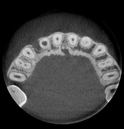 歯科用CT